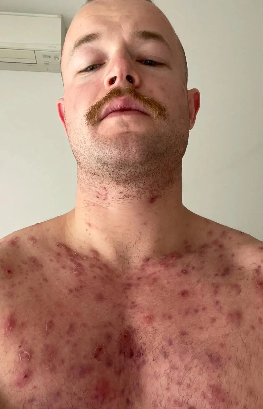 DrhorseJuice in 2020, with cystic acne across his chest and neck